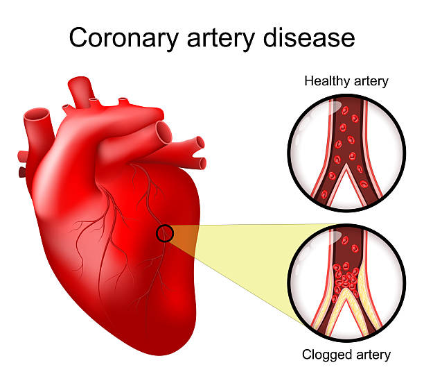 Read more about the article What Coronary Heart Disease Really Is (and How It Differs From General Heart Disease)